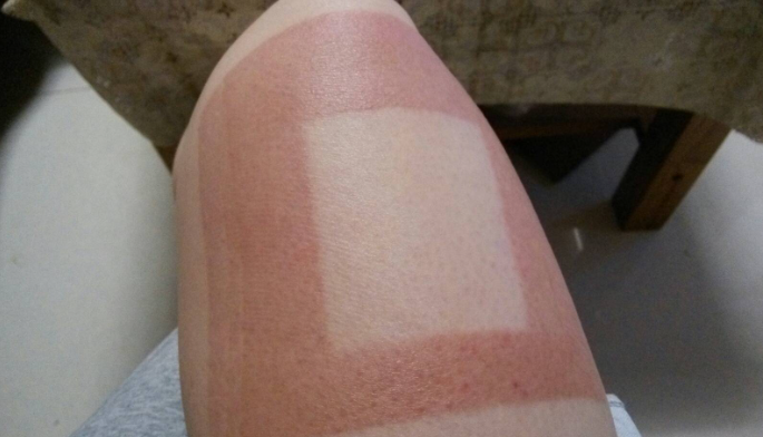 贴膏药过敏怎么办-修康药业